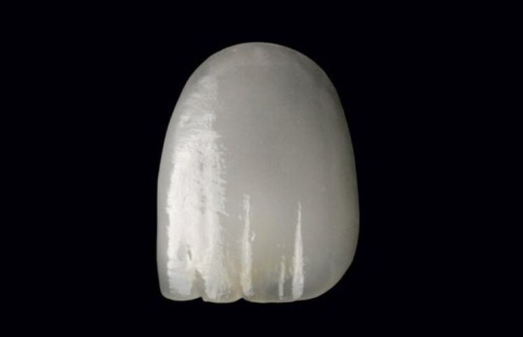 Feldspathic veneers have been made popular by patients for their non-invasive preparation requirements, and their ability to allow the existing tooth shades to shine through