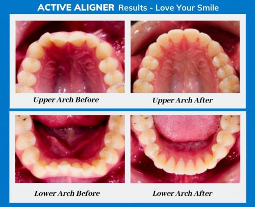 Active Aligners before and after review